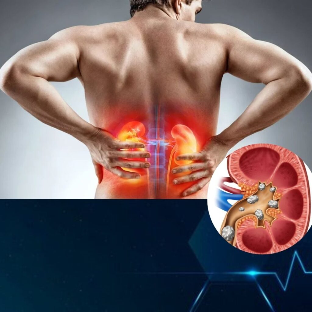 7mm Kidney stone 7mm Kidney stone