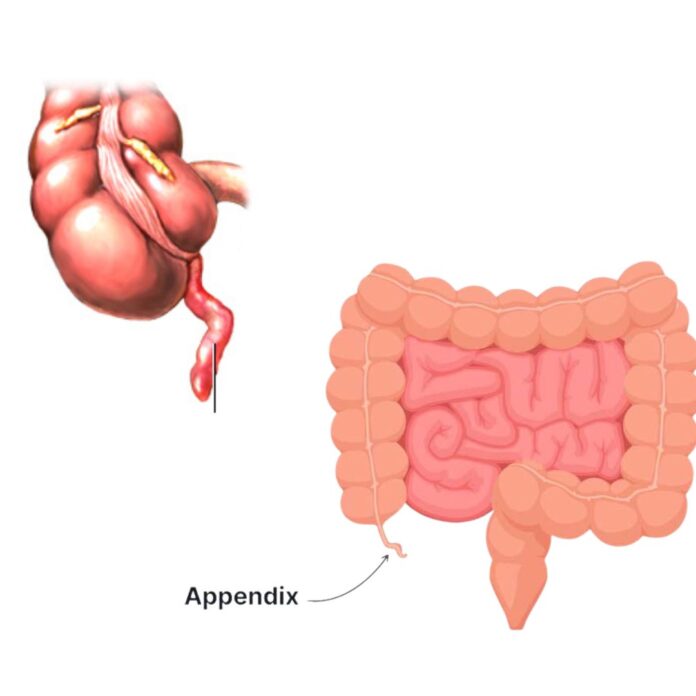 Main cause of appendictis
