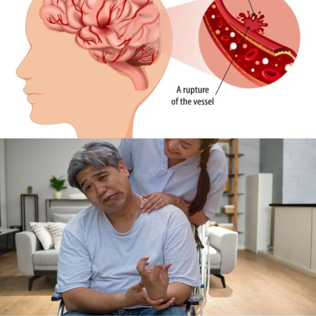 What is a paralysis attack